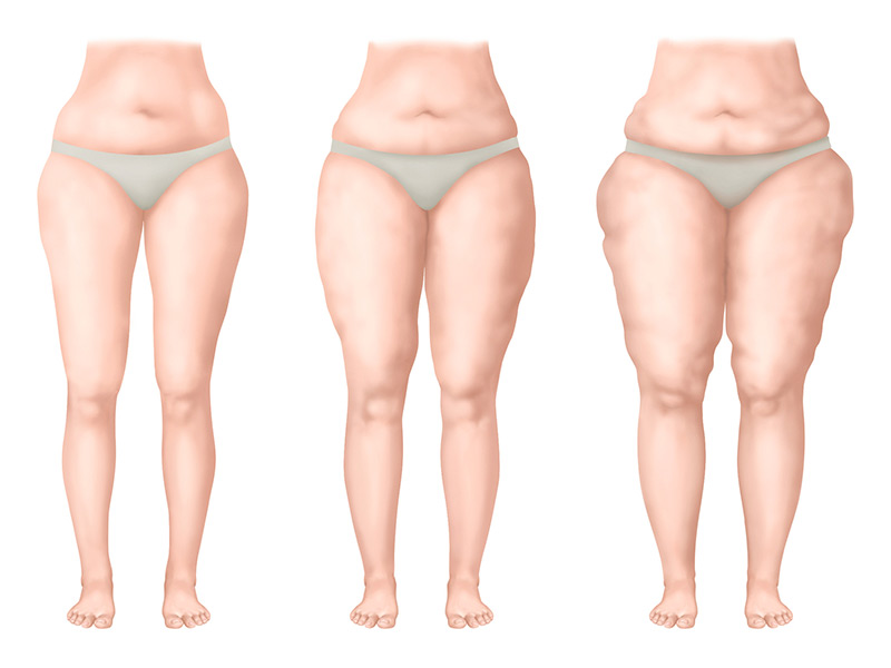 El gráfico muestra los estadios del lipedema