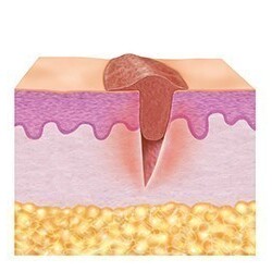 2. Granulation phase (proliferative phase) 2. Granulation phase (proliferative phase)