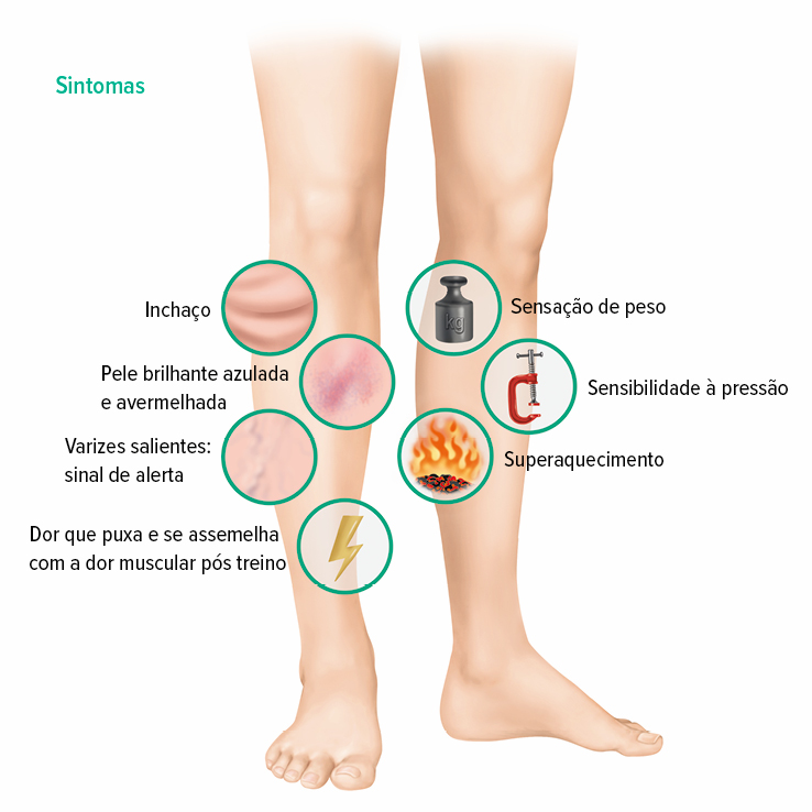 Sintomas de trombose venosa profunda (TVP) Sintomas de trombose venosa profunda (TVP)