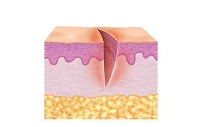1. Oprensningsfase (inflammationsfase)