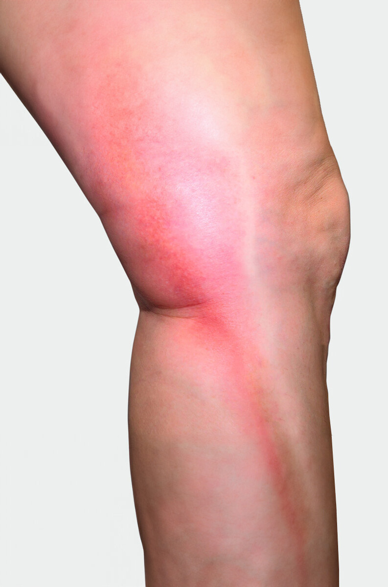 Beininnenseite mit Rötung, die auf eine Thrombose hindeutet Beininnenseite mit Rötung, die auf eine Thrombose hindeutet